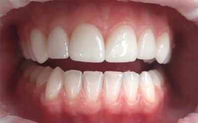 Vorher-Nachher-Behandlungs-Nachher-Bild Zahnarzt Muster jadento