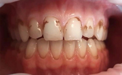Vorher-Nachher-Behandlungs-Vorher-Bild Zahnarzt Muster jadento
