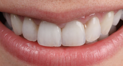 Vorher-Nachher-Bild | Parodontologie, Veneers  | von Dr. med. dent.  Alexander Vuck  | Düsseldorf  14bfa6bb Nachher-Bild