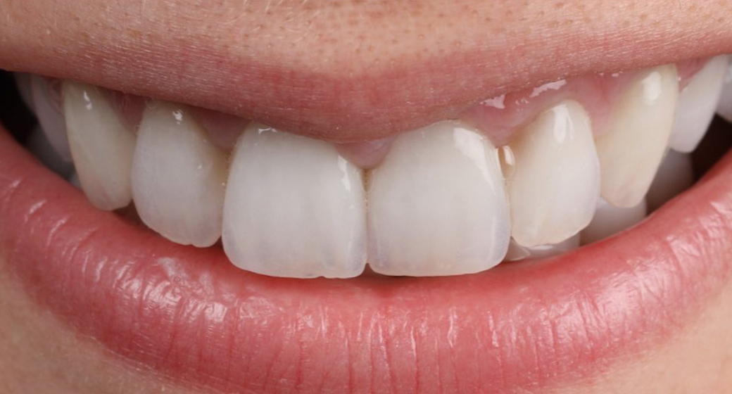 Behandlung Vorher-Nachher-Bild | Parodontologie, Veneers  | von Dr. med. dent.  Alexander Vuck  | Düsseldorf  14bfa6bb Vorher-Bild