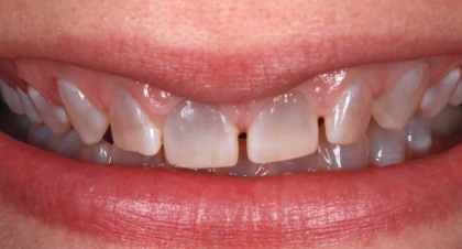 Vorher-Nachher-Bild | Parodontologie, Veneers  | von Dr. med. dent.  Alexander Vuck  | Düsseldorf  14bfa6bb Vorher-Bild