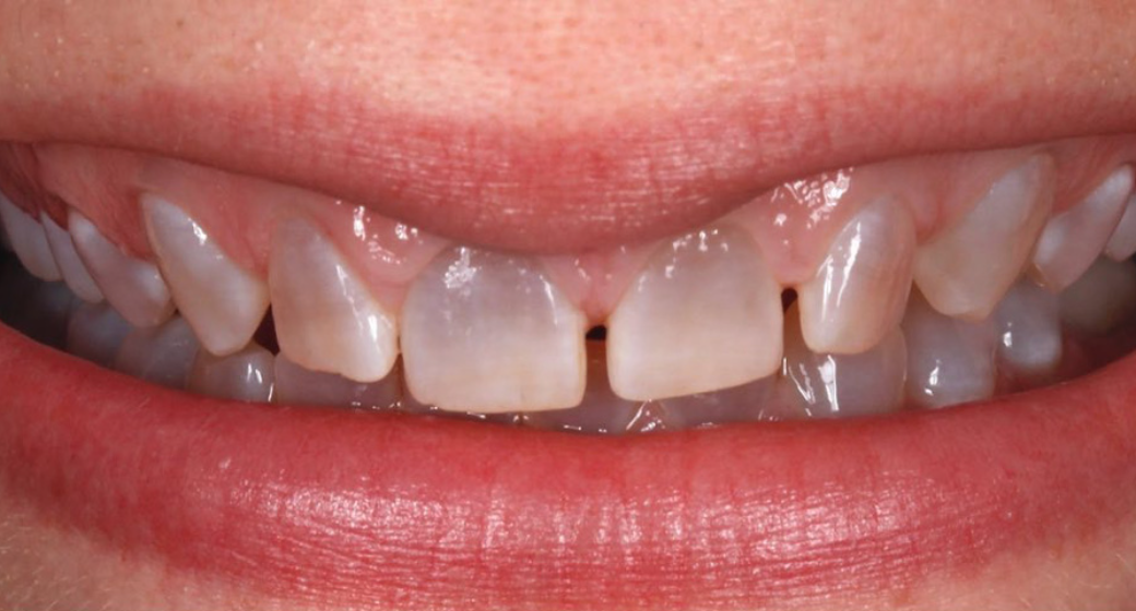 Behandlung Vorher-Nachher-Bild | Parodontologie, Veneers  | von Dr. med. dent.  Alexander Vuck  | Düsseldorf  14bfa6bb Nachher-Bild