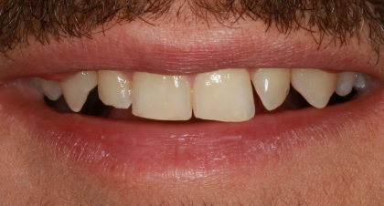 Vorher-Nachher-Bild | Veneers von Dr. med. dent. Moritz Boeddinghaus | Herne 1be3bc32 Vorher-Bild