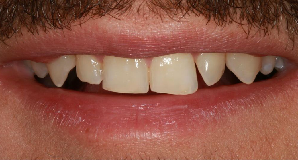 Behandlung Vorher-Nachher-Bild | Veneers von Dr. med. dent. Moritz Boeddinghaus | Herne 1be3bc32 Nachher-Bild