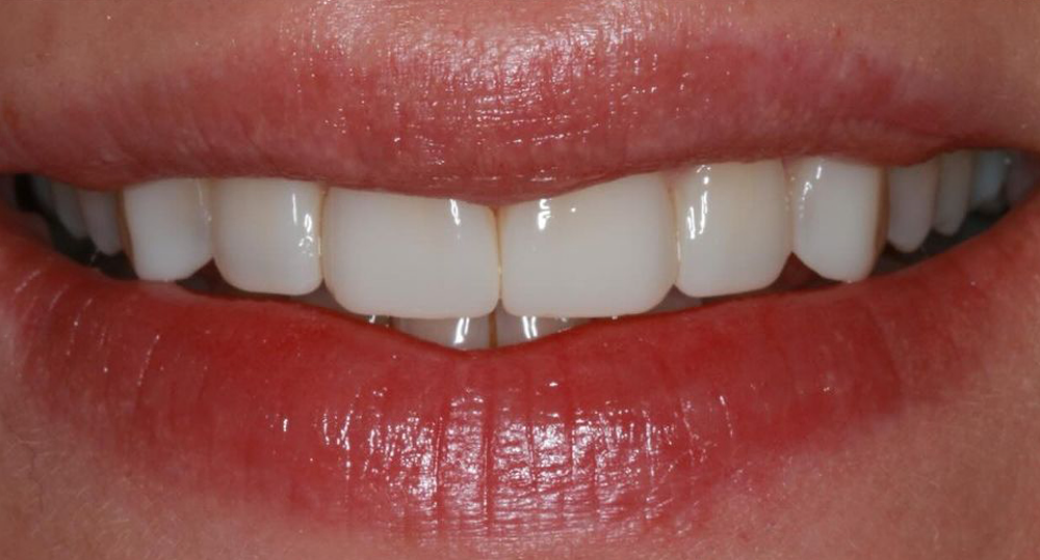 Vorher-Nachher-Bild | Veneers von Dr. med. dent. Moritz Boeddinghaus | Herne 1be3bc32 Nachher-Bild