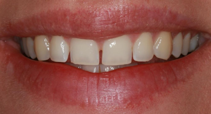 Vorher-Nachher-Bild | Veneers von Dr. med. dent. Moritz Boeddinghaus | Herne 1be3bc32 Vorher-Bild