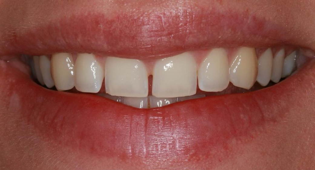 Behandlung Vorher-Nachher-Bild | Veneers von Dr. med. dent. Moritz Boeddinghaus | Herne 1be3bc32 Nachher-Bild