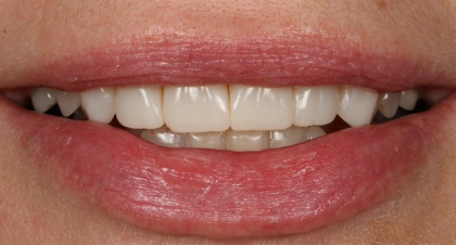 Vorher-Nachher-Bild | Veneers von Dr. med. dent. Moritz Boeddinghaus | Herne 1be3bc32 Nachher-Bild