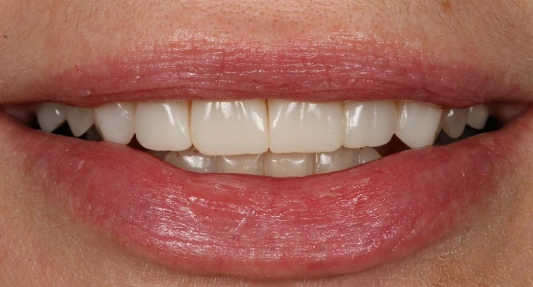 Vorher-Nachher-Bild | Veneers von Dr. med. dent. Moritz Boeddinghaus | Herne 1be3bc32 Nachher-Bild