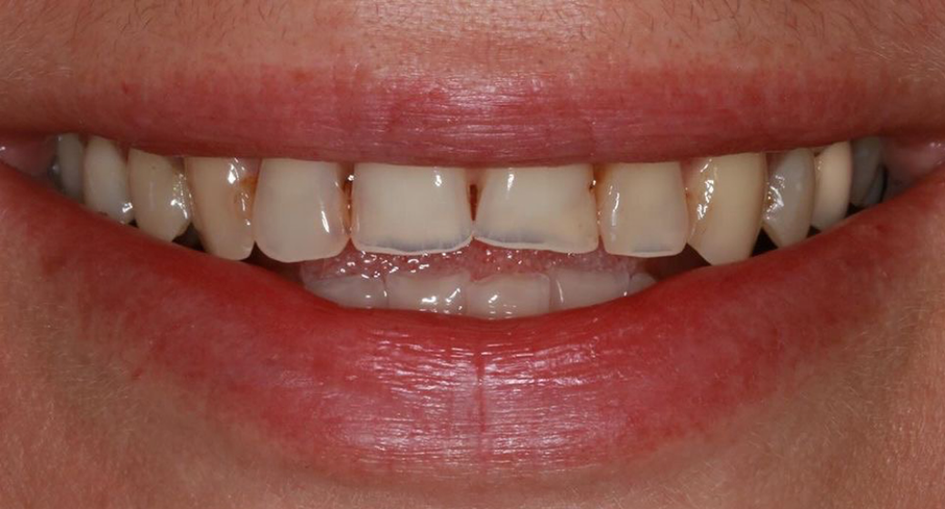 Vorher-Nachher-Bild | Veneers von Dr. med. dent. Moritz Boeddinghaus | Herne 1be3bc32 Vorher-Bild