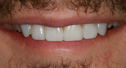 Vorher-Nachher-Bild | Veneers von Dr. med. dent. Moritz Boeddinghaus | Herne 1be3bc32 Nachher-Bild