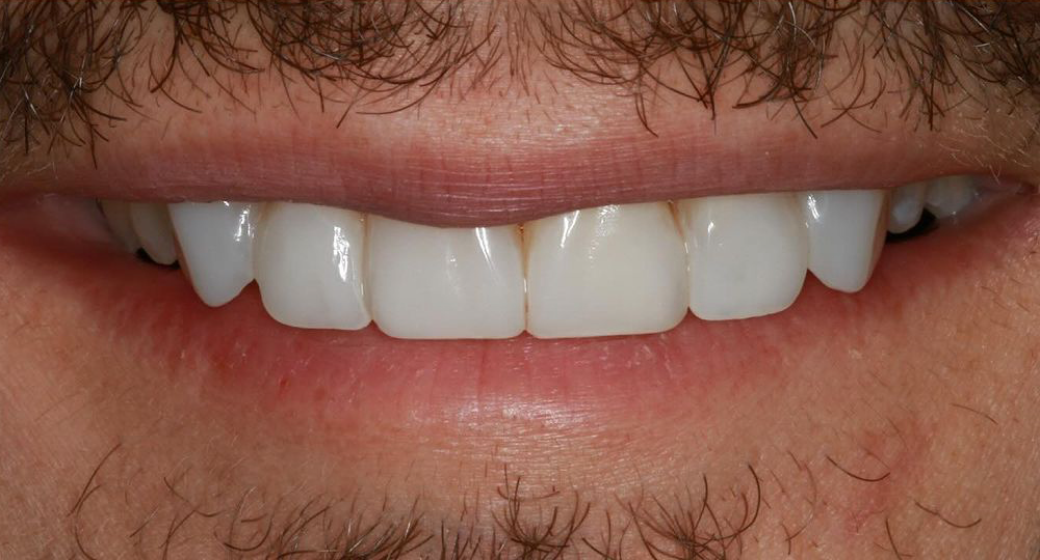 Behandlung Vorher-Nachher-Bild | Veneers von Dr. med. dent. Moritz Boeddinghaus | Herne 1be3bc32 Vorher-Bild