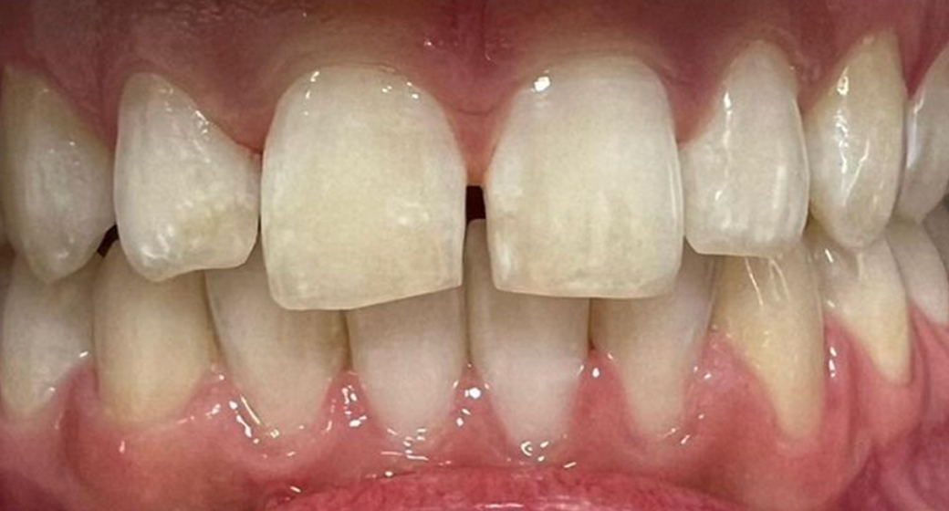 Vorher-Nachher-Bild | Veneers von Dr. med. dent. Tina Hornbacher | Schwäbisch-Gmünd 25ddc0f8 Vorher-Bild