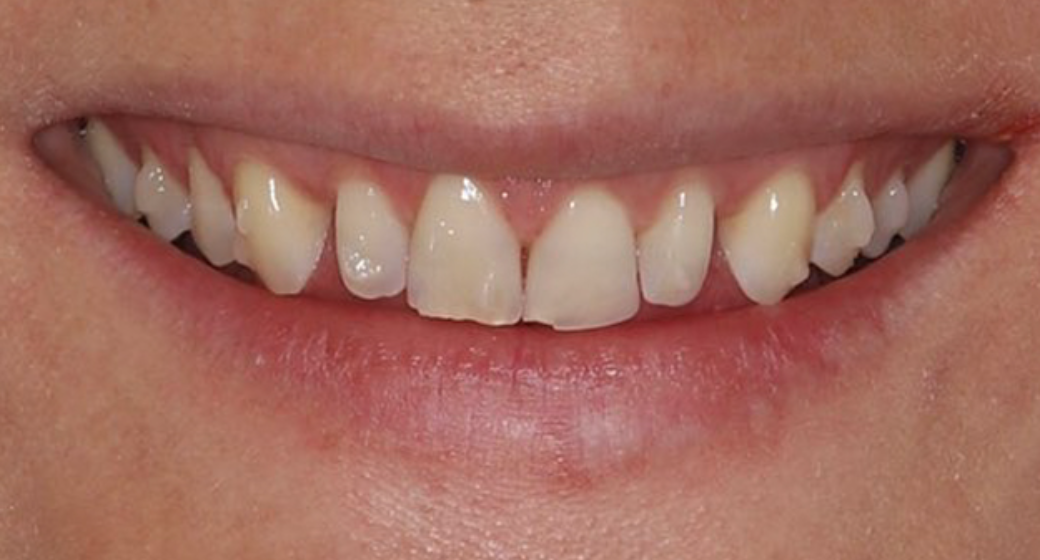 Vorher-Nachher-Bild | Veneers  | von    | Köln 26337353 Vorher-Bild