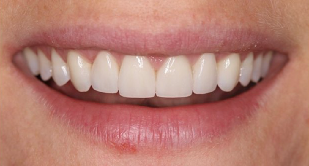 Vorher-Nachher-Bild | Veneers  | von    | Köln 26337353 Nachher-Bild