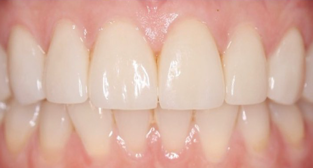 Behandlung Vorher-Nachher-Bild | Bleaching, Kronen, Veneers  | von Dr. Dorothée Jarleton | Köln 26337353 Vorher-Bild