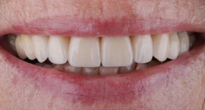 Vorher-Nachher-Bild | Kronen, Veneers  | von Dr. med. dent.  Ulf  Schladebach  | Paderborn  32bb90e8 Nachher-Bild