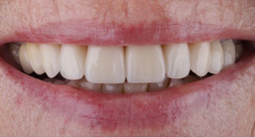 Behandlung Vorher-Nachher-Bild | Kronen, Veneers  | von Dr. med. dent.  Ulf  Schladebach  | Paderborn  32bb90e8 Vorher-Bild