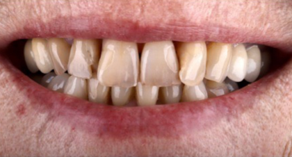 Vorher-Nachher-Bild | Kronen, Veneers  | von Dr. med. dent.  Ulf  Schladebach  | Paderborn  32bb90e8 Vorher-Bild