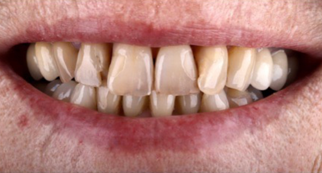 Behandlung Vorher-Nachher-Bild | Kronen, Veneers  | von Dr. med. dent.  Ulf  Schladebach  | Paderborn  32bb90e8 Nachher-Bild