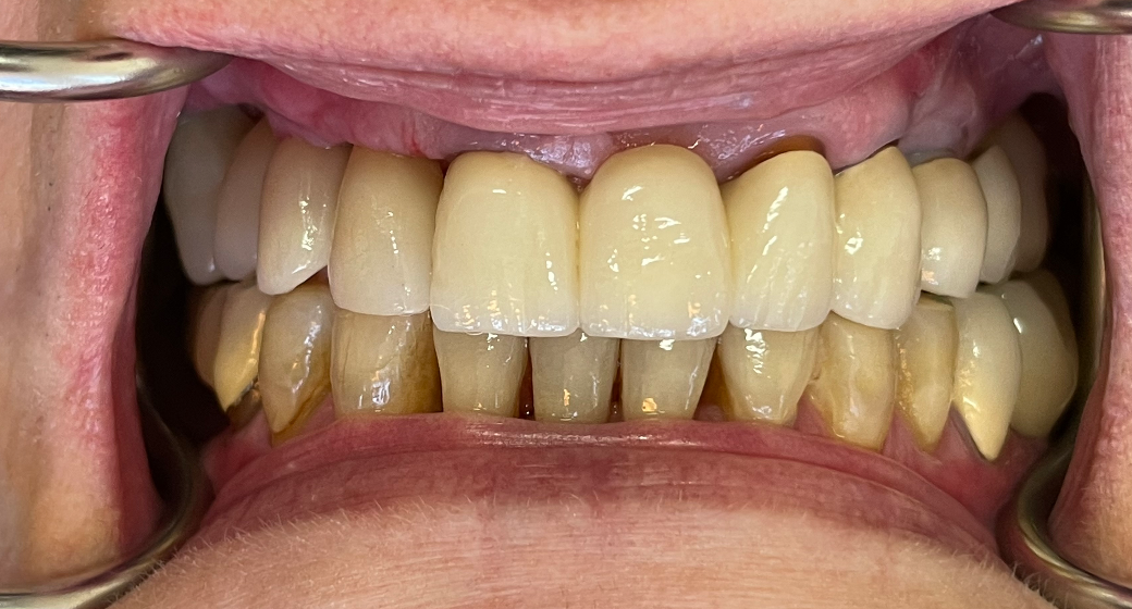 Behandlung Vorher-Nachher-Bild | Implantate | von med. dent. Tanja Bornmann | Berlin 35f4a8d4 Vorher-Bild
