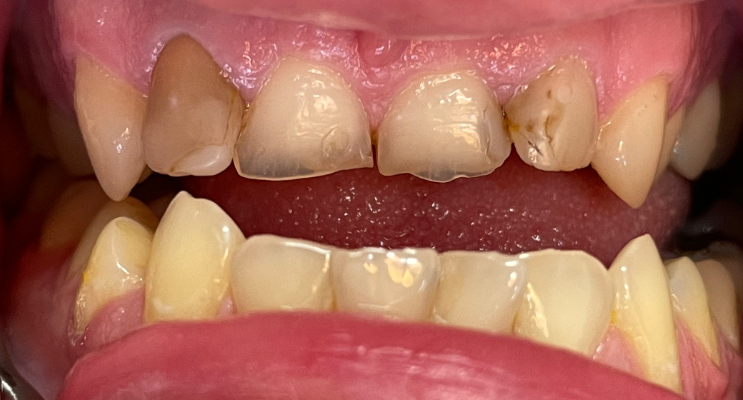 Behandlung Vorher-Nachher-Bild | Veneers | von med. dent. Tanja Bornmann | Berlin 35f4a8d4 Nachher-Bild