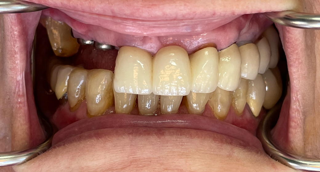 Behandlung Vorher-Nachher-Bild | Implantate | von med. dent. Tanja Bornmann | Berlin 35f4a8d4 Nachher-Bild