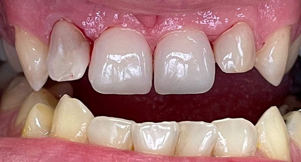 Behandlung Vorher-Nachher-Bild | Veneers | von med. dent. Tanja Bornmann | Berlin 35f4a8d4 Vorher-Bild