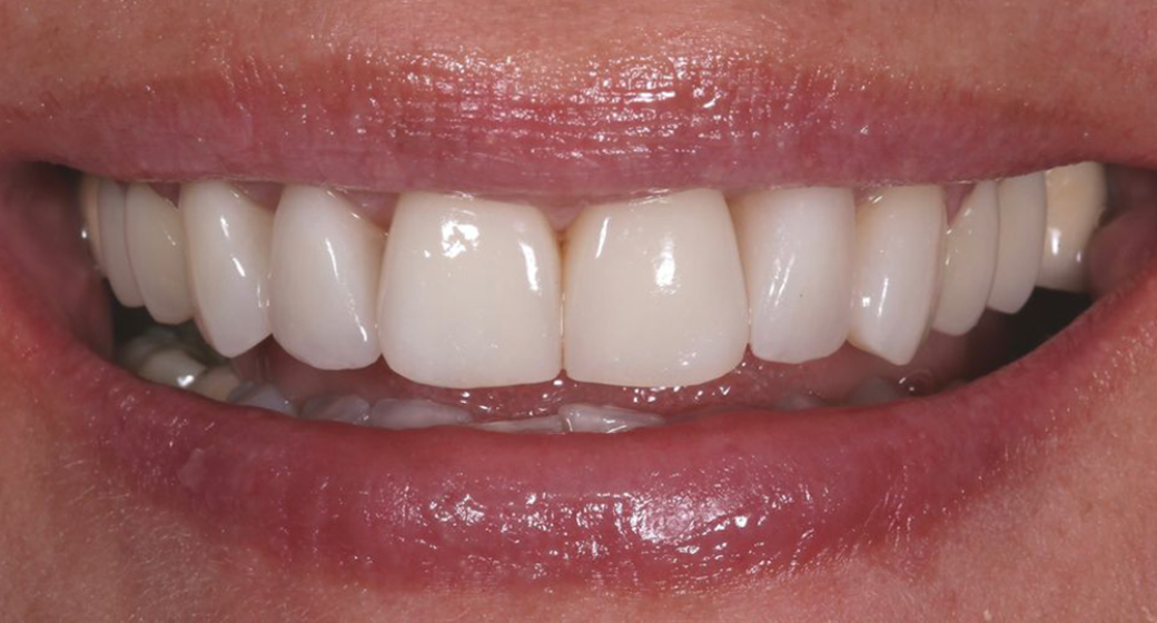 Behandlung Vorher-Nachher-Bild | Veneers von Dr. med. dent. Lale Acanal-Lozankovski | Baden-Baden 559cb990 Vorher-Bild