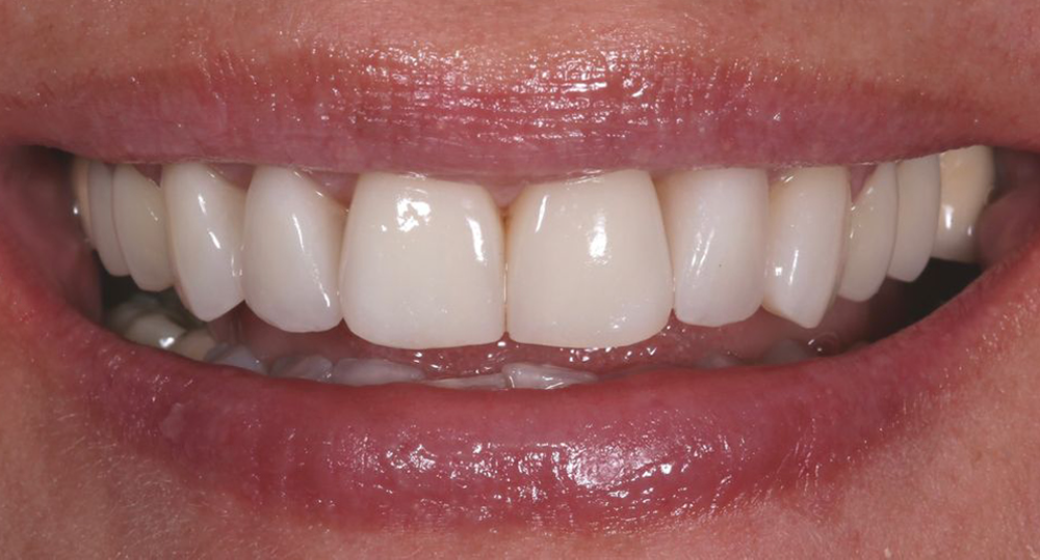 Vorher-Nachher-Bild | Veneers von Dr. med. dent. Lale Acanal-Lozankovski | Baden-Baden 559cb990 Nachher-Bild