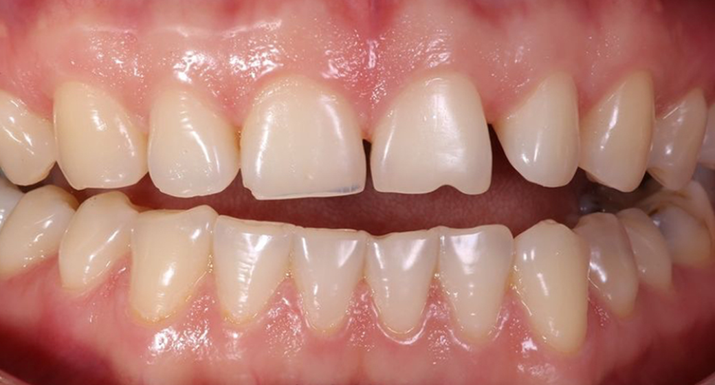 Vorher-Nachher-Bild | Veneers von Dr. med. dent. Lale Acanal-Lozankovski | Baden-Baden 559cb990 Vorher-Bild