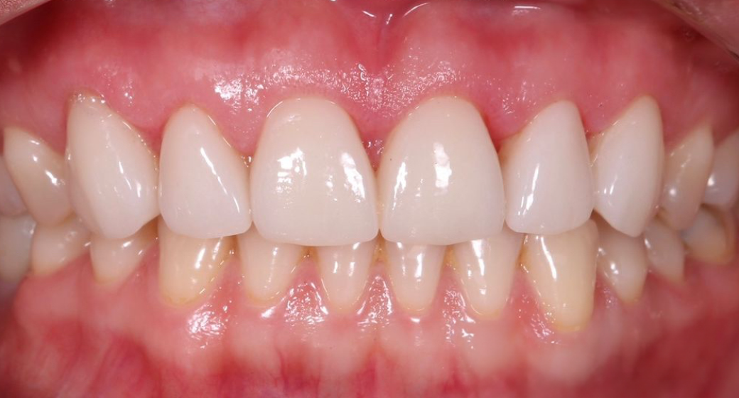 Behandlung Vorher-Nachher-Bild | Veneers von Dr. med. dent. Lale Acanal-Lozankovski | Baden-Baden 559cb990 Vorher-Bild