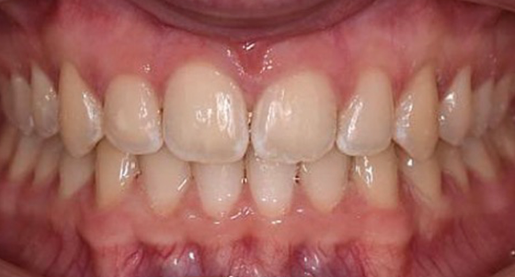 Behandlung Vorher-Nachher-Bild | Aligner  | von Dr. med. dent.  Nassim  Trips  | Rastatt 735b90b4 Vorher-Bild