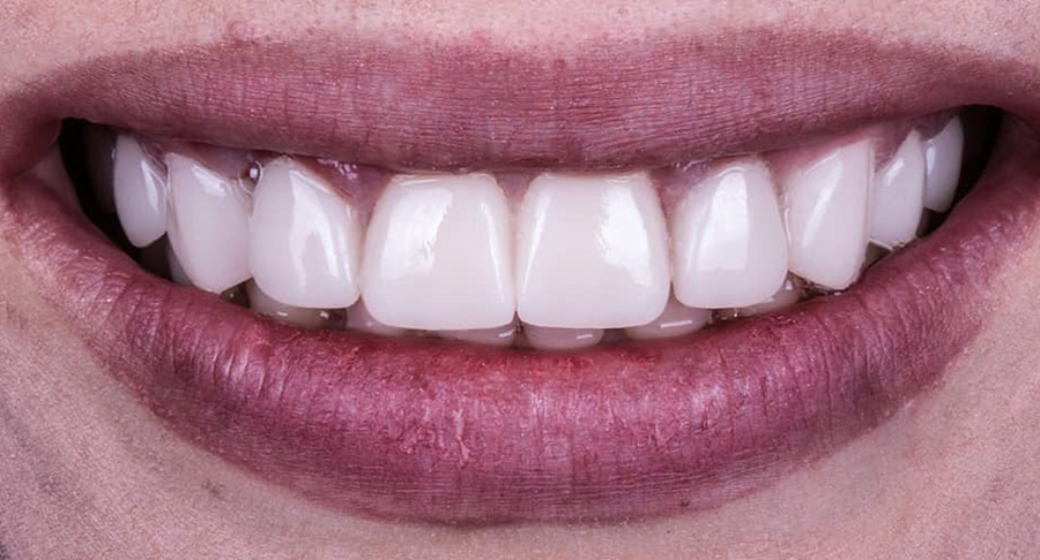 Behandlung Vorher-Nachher-Bild | Veneers  | von Dr. med. dent. Pourya Farrokh | Berlin 8e6b42f1 Vorher-Bild