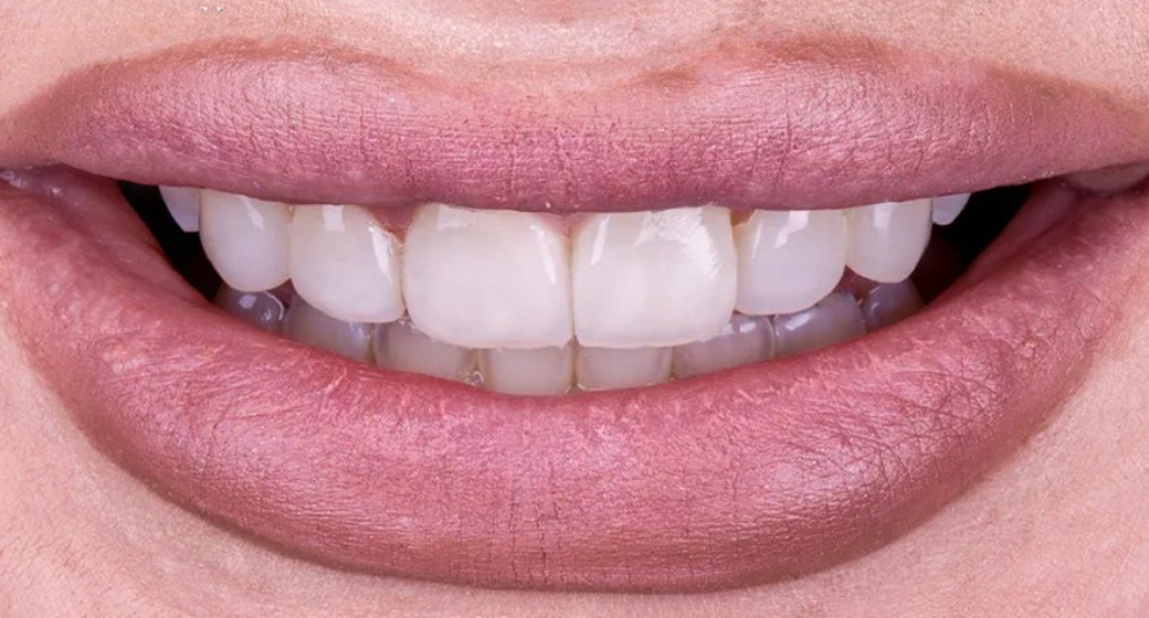 Vorher-Nachher-Bild | Veneers  | von Dr. med. dent. Pourya Farrokh | Berlin 8e6b42f1 Nachher-Bild