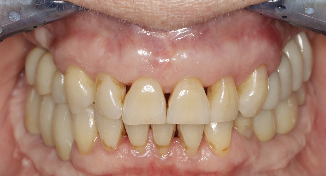 Behandlung Vorher-Nachher-Bild | Implantate von Dr. med. dent. Kai Zwanzig | Bielefeld 9461cce2 Vorher-Bild