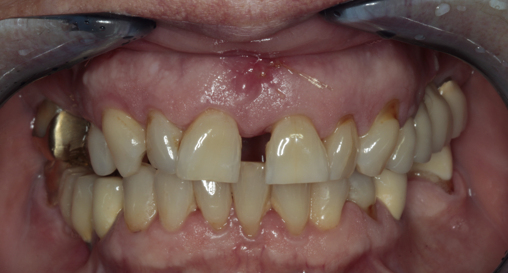 Behandlung Vorher-Nachher-Bild | Implantate von Dr. med. dent. Kai Zwanzig | Bielefeld 9461cce2 Nachher-Bild