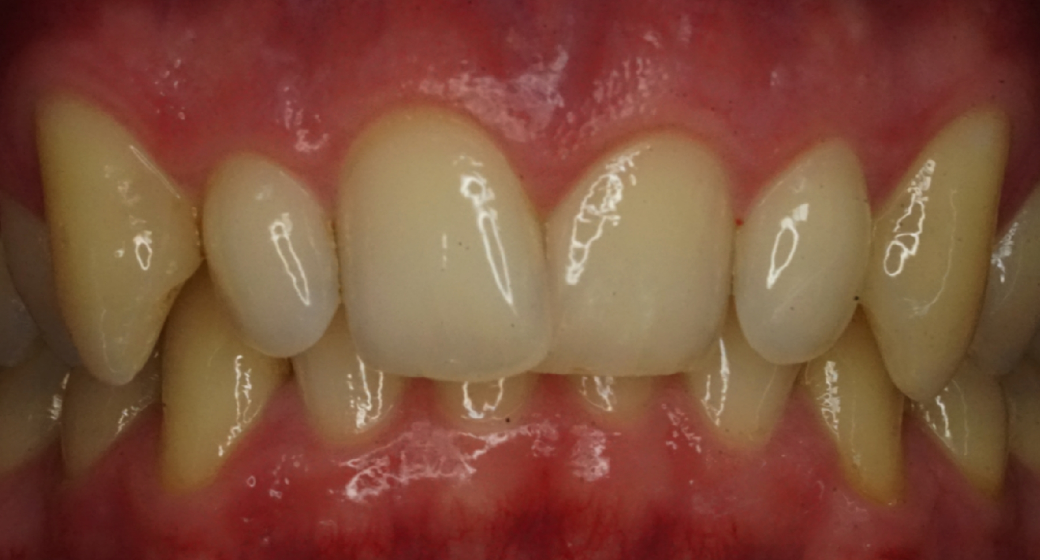 Vorher-Nachher-Bild | Aligner, Bleaching, Prophylaxe  | von    | München  98b29795 Vorher-Bild