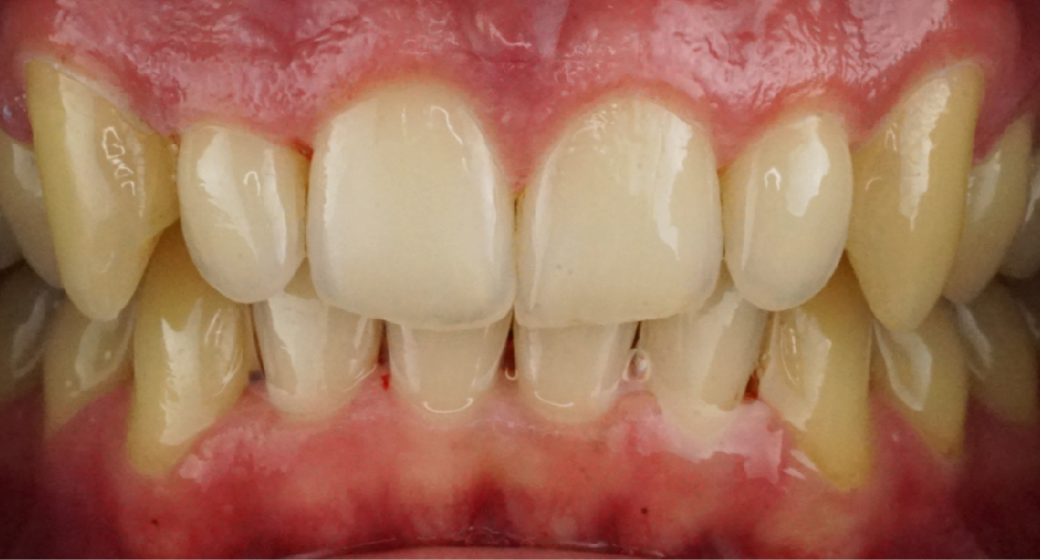 Vorher-Nachher-Bild | Aligner, Bleaching, Prophylaxe  | von    | München  98b29795 Nachher-Bild