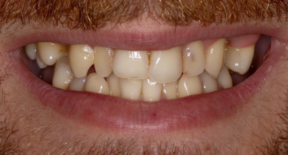 Vorher-Nachher-Bild | Implantate  | von Dr. med. dent.  Nebojsa  Stankovic  | Hannover  a3f390d8 Vorher-Bild