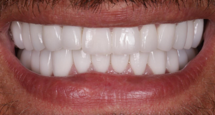 Vorher-Nachher-Bild | Veneers  | von Dr. med. dent.  Nebojsa  Stankovic  | Hannover  a3f390d8 Nachher-Bild