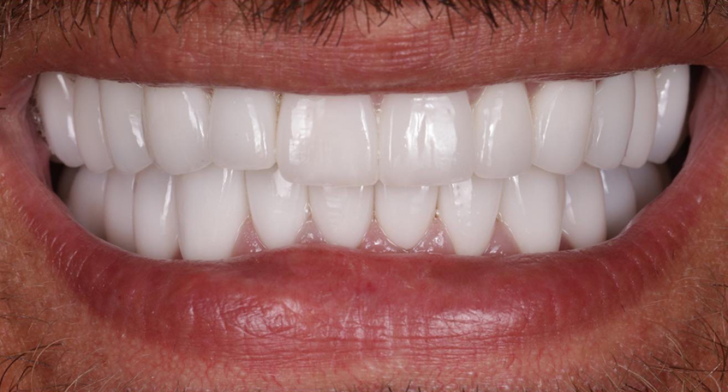 Behandlung Vorher-Nachher-Bild | Veneers  | von Dr. med. dent.  Nebojsa  Stankovic  | Hannover  a3f390d8 Vorher-Bild