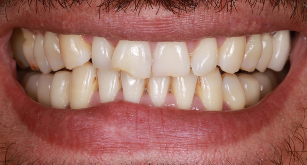 Vorher-Nachher-Bild | Veneers  | von Dr. med. dent.  Nebojsa  Stankovic  | Hannover  a3f390d8 Vorher-Bild