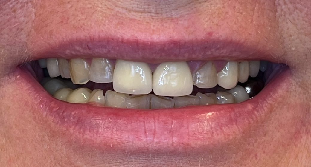 Behandlung Vorher-Nachher-Bild | Brücken, Kronen, Parodontologie  | von ZA Jubin Banivaheb  | Düsseldorf  a5bfc9e0 Nachher-Bild