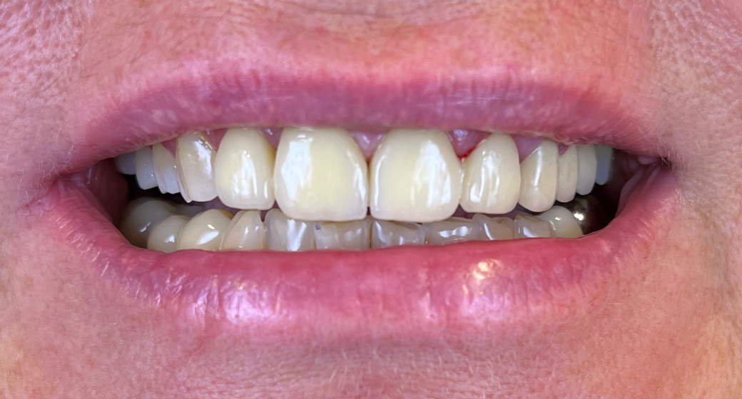 Behandlung Vorher-Nachher-Bild | Brücken, Kronen, Parodontologie  | von ZA Jubin Banivaheb  | Düsseldorf  a5bfc9e0 Vorher-Bild