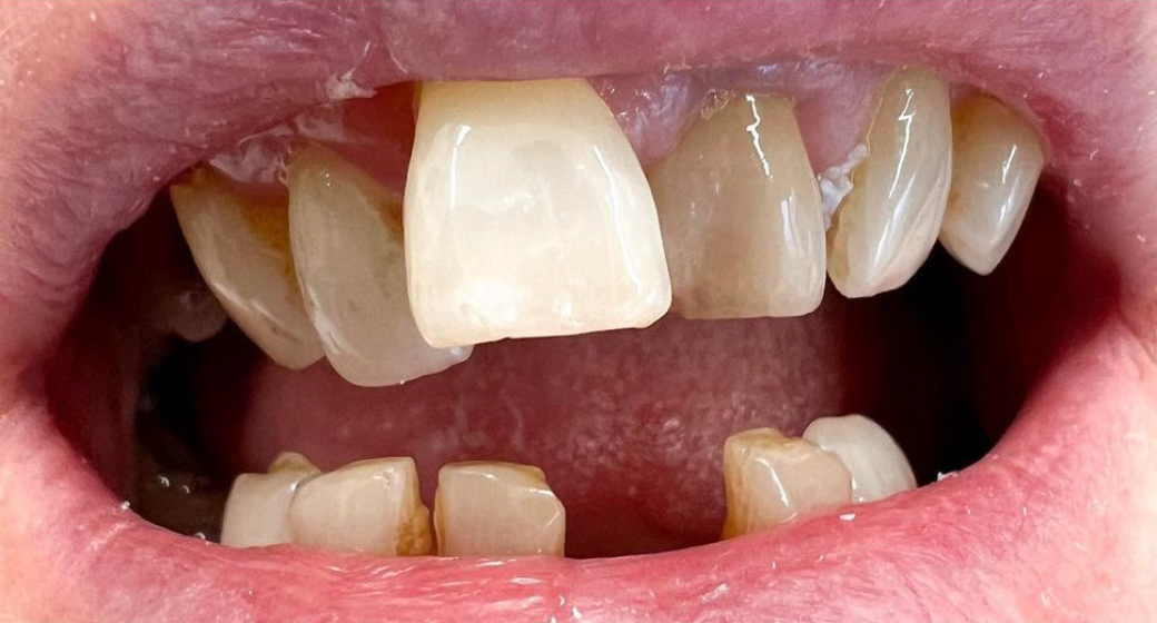 Behandlung Vorher-Nachher-Bild | Brücken, Kronen  | von Dr. med. dent. Lars Wagenmann | Frechen ab817c93 Nachher-Bild