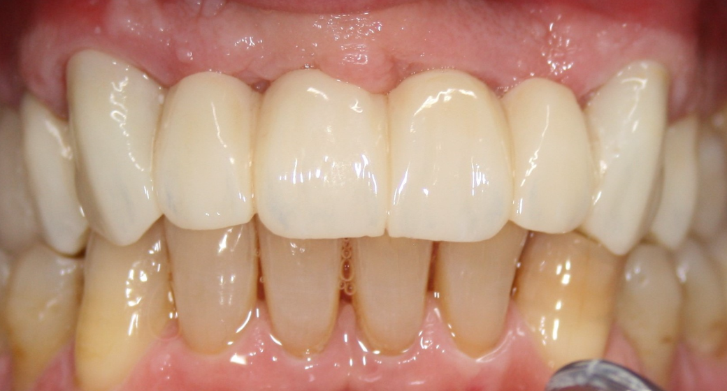 Behandlung Vorher-Nachher-Bild | Brücken von  Ahmad Saleh | Düsseldorf c0c7c76d Vorher-Bild