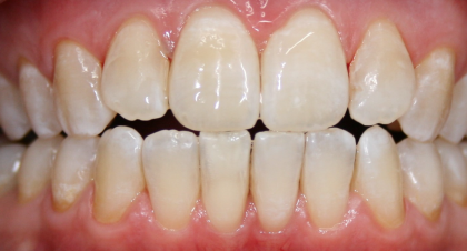 Vorher-Nachher-Bild | Prophylaxe von  Ahmad Saleh | Düsseldorf c0c7c76d Nachher-Bild