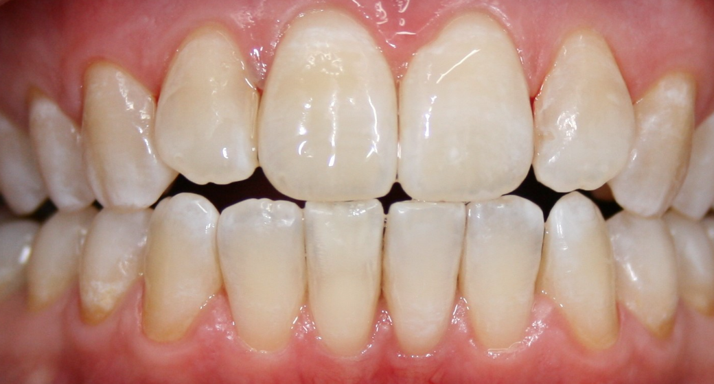 Vorher-Nachher-Bild | Prophylaxe von  Ahmad Saleh | Düsseldorf c0c7c76d Nachher-Bild