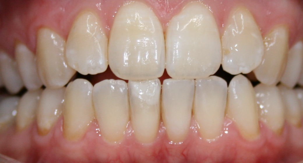 Vorher-Nachher-Bild | Prophylaxe von  Ahmad Saleh | Düsseldorf c0c7c76d Vorher-Bild